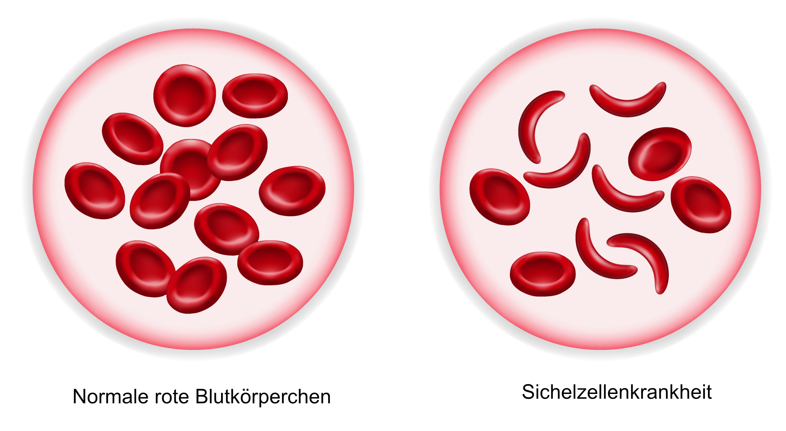 Sichelzellenkrankheit